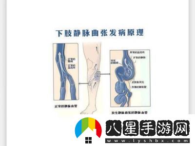 日系裸妝風格與女士靜脈曲張成因詳解