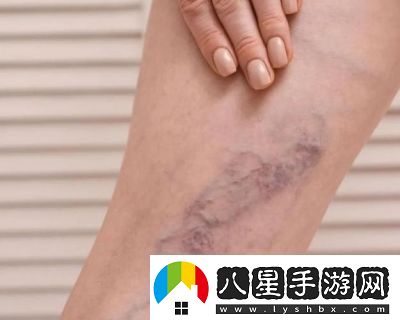 日系裸妝風格與女士靜脈曲張成因詳解